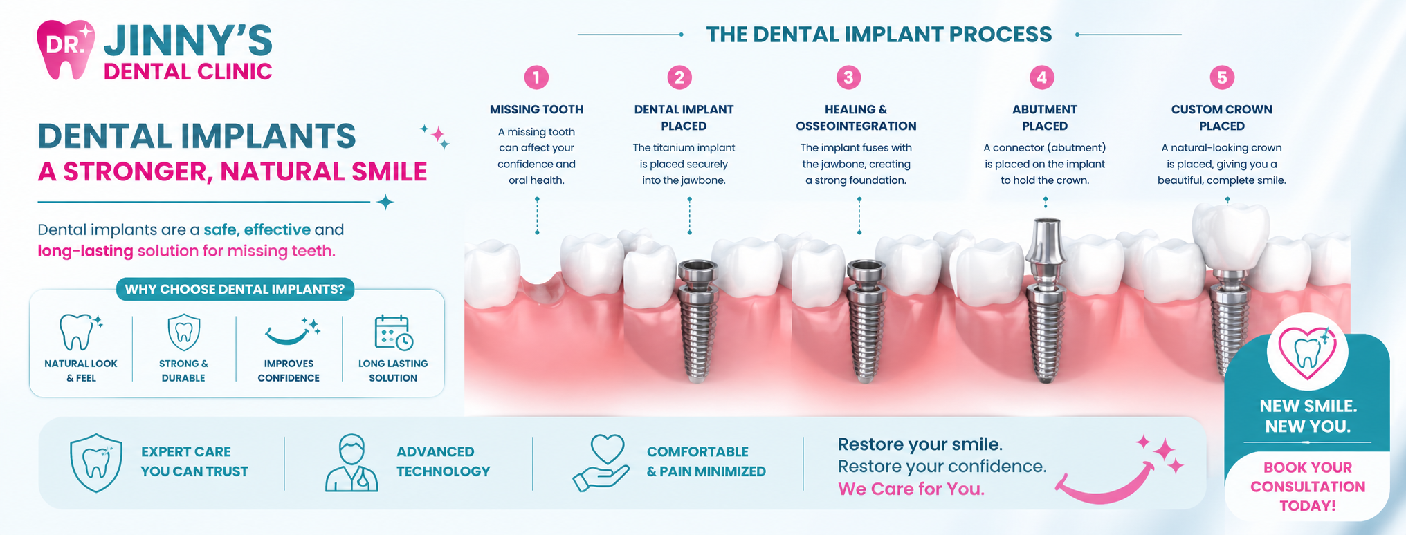 Dental implants vs dentures comparison