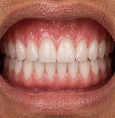 After dental implant — natural looking tooth replacement