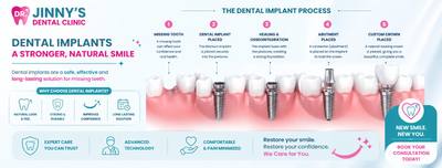 Dental implants vs dentures comparison